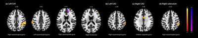 Association of <mark class="highlighted">clozapine</mark> with structural and resting-state functional abnormalities of the hippocampus in chronic schizophrenia